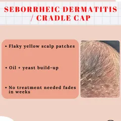 For new parents, not all baby rashes are a cause for panic. This is Seborrheic Dermatitis, also known as cradle cap. It appears as flaky yellow patches from oil and yeast build-up and typically fades on its own in a few weeks without any treatment.