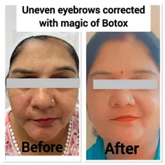 Botox can be used with precision to correct asymmetries, like these uneven eyebrows. A few carefully placed injections helped relax the muscle pulling one brow down, creating a more balanced and harmonious facial expression.