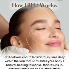 HIFU works by delivering controlled micro-injuries deep within the skin. This process stimulates your body’s natural healing response, leading to the production of new collagen and a tightening effect from within.