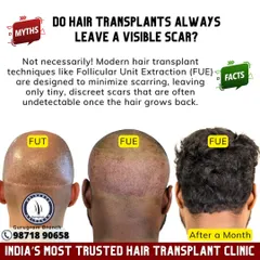 **Myth:** Hair transplants always leave a visible scar. **Fact:** Not with modern techniques. The FUE method I use leaves only tiny, dot-like scars in the donor area that are virtually undetectable once the hair grows back.