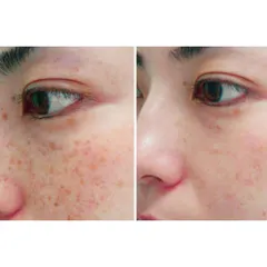 Pigmentation and dark spots are often signs of an internal Pitta imbalance. My Ayurvedic pigmentation treatment focuses on purifying the blood with herbs like Manjistha and Turmeric. This image shows how this holistic approach can lead to a clearer, more even-toned complexion over time, healing the skin from the root cause.