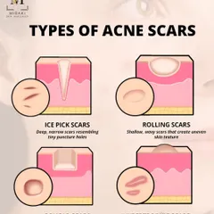 An educational graphic showing the different types of acne scars. Identifying your scar type is the first step toward finding the right treatment.
