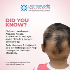 Did you know that hair loss conditions like Alopecia Areata can also affect children? It often appears as patchy hair loss and can be distressing for both the child and parents. I believe early and gentle intervention is key to managing the condition effectively.