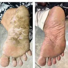 Soothing Severe Palmoplantar Keratoderma. This condition causes painful, thickened skin on the feet. This transformation shows the dramatic improvement after a customized treatment plan involving keratolytic agents and intensive moisturizing therapy.