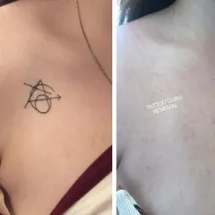 An abstract symbol tattoo removed from the chest. The after photo shows clean skin with no trace of the original fine-line tattoo.