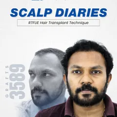 Mr. Mithun’s new, dense hairline was achieved by transplanting 3,589 grafts using the Real-Time Follicular Unit Extraction (RT-FUE) technique. This method ensures high graft survival for a fuller, more natural look.
