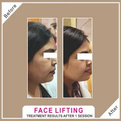 A defined jawline and lifted appearance after just one session of our non-surgical face lifting treatment. We use advanced technologies like HIFU to stimulate collagen and tighten facial tissues for a naturally youthful result.