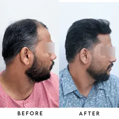 From the other side, you can see the consistent density and natural angle of the transplanted hair, ensuring a balanced look from all perspectives.