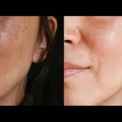 Here is another example of a patient's progress in treating facial pigmentation. The after photo shows a clearer and more uniform complexion, achieved through a series of customized laser toning sessions.