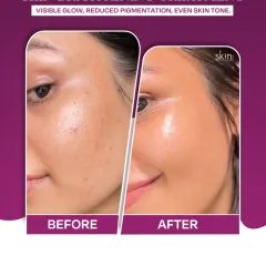 A clear before-and-after comparison demonstrating the effectiveness of my skin brightening treatments. The images show a visible reduction in pigmentation and a significant improvement in overall glow and skin tone.