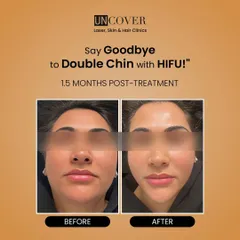 A clear before and after of HIFU for double chin reduction. The treatment effectively targets and reduces fat deposits under the chin, resulting in a more sculpted and defined jawline. These results were achieved in just 1.5 months.