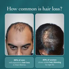 **How Common is Hair Loss?** This graphic provides key statistics, showing that 96% of men will experience hair loss and 40% of women show visible thinning by age 50. It normalizes the experience and reinforces that we see and treat it every day.