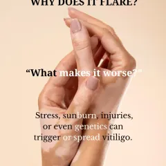 Certain factors can trigger or worsen vitiligo. Stress, sunburn, skin injuries, and genetics can all play a role in its flare-ups, making a holistic management approach crucial.