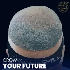 Here you can see the transplanted area from the back. The headband is used for comfort post-procedure. Our FUE technique ensures that the results are not just effective but the process is also designed for patient comfort.