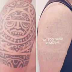 Removing a large, dense tribal tattoo like this one on the shoulder takes time and multiple sessions. This before and after photo shows the significant fading possible, clearing the skin for a fresh start.