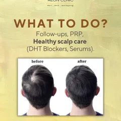To maintain your overall hair health post-transplant, we recommend follow-ups, supportive treatments like PRP, and a good scalp care routine with DHT blockers and serums.