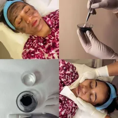 A four-part image showing the key stages of a Carbon Laser Peel. It includes the preparation of the carbon paste, its application, and the client's relaxed state during the rejuvenating treatment.