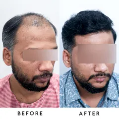 This angled view demonstrates the complete coverage of the frontal and mid-scalp regions, eliminating the appearance of thinning.