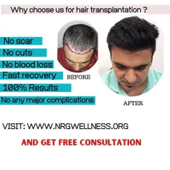 Why choose us for your hair transplantation? We guarantee a procedure with no scars or cuts, fast recovery, and 100% results, all with no major complications. Visit us for a free consultation to learn more.