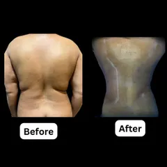 This demonstrates the power of Vaser liposuction combined with BodyTite radiofrequency technology. For this patient, we performed a revision procedure to remove stubborn fat from the back and flanks while tightening the skin, successfully restoring a defined, hourglass waistline.