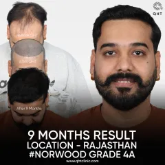 This patient from Rajasthan had Norwood Grade 4A baldness. In a single session with 5000 grafts, I restored his hairline and filled in the frontal, mid-scalp, and temple areas, achieving this full look in just 9 months.