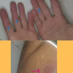 This photo shows the same patient's hands after completing the course of Ayurvedic medication. The lesions have healed, and the skin has cleared up significantly, providing much-needed relief without harsh side effects.