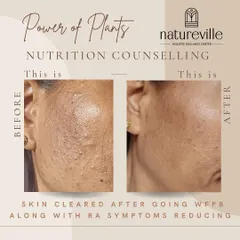 The power of plants is visible. This client was suffering from Rheumatoid Arthritis and after following my protocols, not only did her RA symptoms improve, but her skin cleared up beautifully. Healing happens from the inside out.