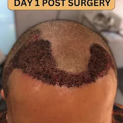 Day 1 post-surgery. The newly implanted grafts are visible. This is the very beginning of the healing and growth process.
