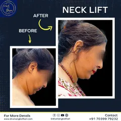 A defined jawline and a smooth neck can dramatically change your profile. This is a real result from a neck lift procedure I performed, showing a significant improvement in skin laxity and contour. It’s about restoring a youthful frame to your face.