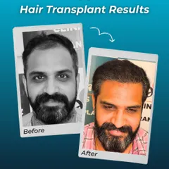 Here, we addressed both a receding hairline and thinning throughout the top. The 'after' photo shows the powerful impact of expert precision in creating a fuller, more robust look.