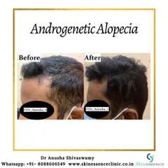 This patient's primary concern was a receding hairline and thinning at the front. The 'after' image demonstrates how a targeted treatment plan can effectively restore hair density and create a stronger, more defined hairline.