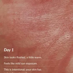 Day 1 after microneedling: Your skin will look flushed and feel warm, similar to a mild sunburn. This is an intentional and positive response, signaling that your skin has entered its repair mode.