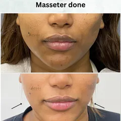 A strong, defined jawline can significantly enhance facial structure. This before and after shows the effect of a masseter treatment, which slims the lower face for a more V-shaped and contoured profile without surgery.