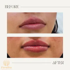 A perfect example of my philosophy on lip fillers: enhancement, not exaggeration. Here, I focused on adding subtle volume and hydration to create a beautifully balanced and natural-looking pout.