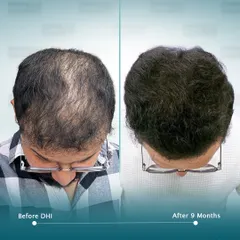 A top-down view of a 25-year-old client who came to us for a correction case. After a previously unsatisfactory procedure elsewhere, we implanted 7,869 hairs. This 9-month result shows the exceptional, natural-looking density we achieved.