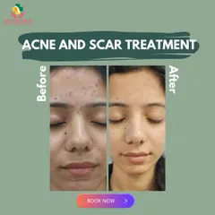 Real results for a real client. This before and after image demonstrates the effectiveness of our customized acne and scar treatment plan. We combine advanced procedures to significantly reduce active acne, clear up post-inflammatory hyperpigmentation, and smooth skin texture.