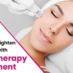 Mesotherapy is another treatment I offer for skin restoration. It involves injecting a cocktail of vitamins, enzymes, and plant extracts to tighten skin, reduce cellulite, and fade fine lines, giving you a refreshed appearance.