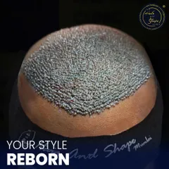 This is what a high-density hair transplant looks like immediately after the procedure. Each follicle is carefully placed at the correct angle and depth to ensure the new hairline grows in a way that is dense, natural, and permanent.