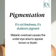 That darkness under your eyes might not be tiredness. It could be pigmentation caused by a melanin overload, which makes the area appear brown or bluish. This requires targeted treatments, not just more sleep.