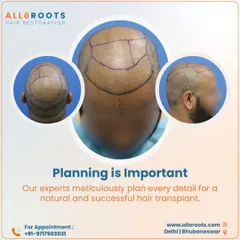 Meticulous planning is the most important part of a successful hair transplant. I map out every detail of the procedure, from donor graft selection to recipient site placement, to ensure the outcome is both natural and sustainable for the long term.
