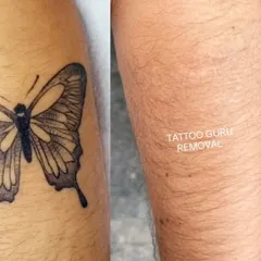 A detailed butterfly tattoo on the arm, shown before treatment and after it has been fully removed, leaving clear skin behind.