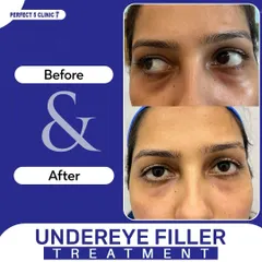 Tired-looking eyes are a common concern we address. This image shows the immediate, rejuvenating effect of our under-eye filler treatment, which reduces hollowness and dark circles for a brighter, more rested look.