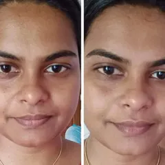 A real before-and-after from using my Anti-Acne Face Pack. You can see the improvement in skin clarity and glow. This pack helps with pimples, black marks, and dullness.