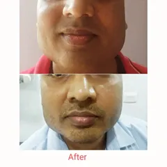 A before-and-after of a male client who underwent a threadlift for cheek lifting and tightening. The result is a subtly lifted mid-face and a more defined jawline, enhancing the facial structure.