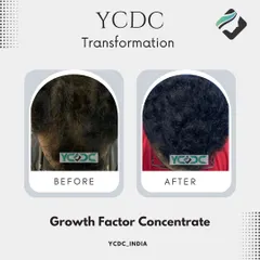 A fantastic transformation achieved with Growth Factor Concentrate (GFC). This image shows a clear improvement in hair quality, density, and coverage after just three months of treatment.