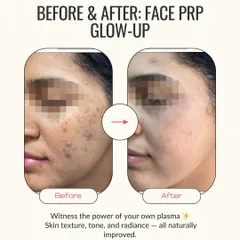 Witness a complete skin glow-up with our Face PRP treatment. By using your body's own plasma, we naturally improve skin texture, tone, and radiance, effectively reducing blemishes and signs of dullness for a truly refreshed look.