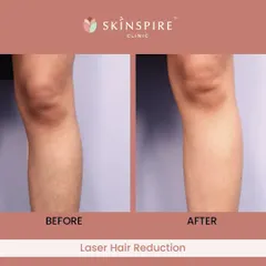 The results speak for themselves. This before-and-after image shows the significant reduction in hair growth and improved skin texture after a course of laser hair reduction sessions. Our goal is to provide a permanent solution to unwanted hair, eliminating the need for constant waxing or shaving.