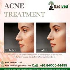 This before-and-after image shows the power of Ayurvedic acne treatment. Instead of harsh topical creams, I use a holistic approach that includes diet, lifestyle changes, and herbal remedies to address the hormonal and digestive roots of acne.