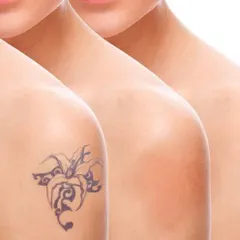 This image illustrates the gradual fading process of laser tattoo removal over multiple sessions. The laser breaks down the ink, and the body's natural processes clear it away over time. This visual represents the expected progression towards clear skin.