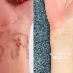 This shows the removal process for a brown ink tattoo on the wrist. Different ink colors and types require slightly different approaches, but the goal is always clear skin.